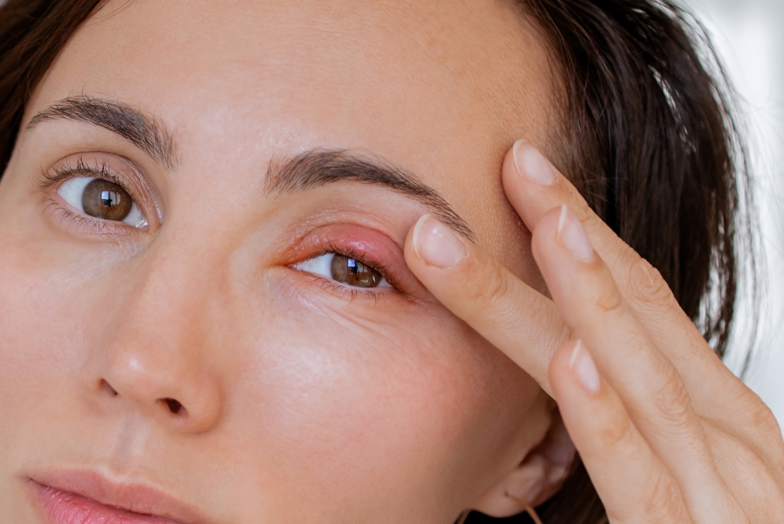 Woman with a stye on her eyelid touching the area around her eye